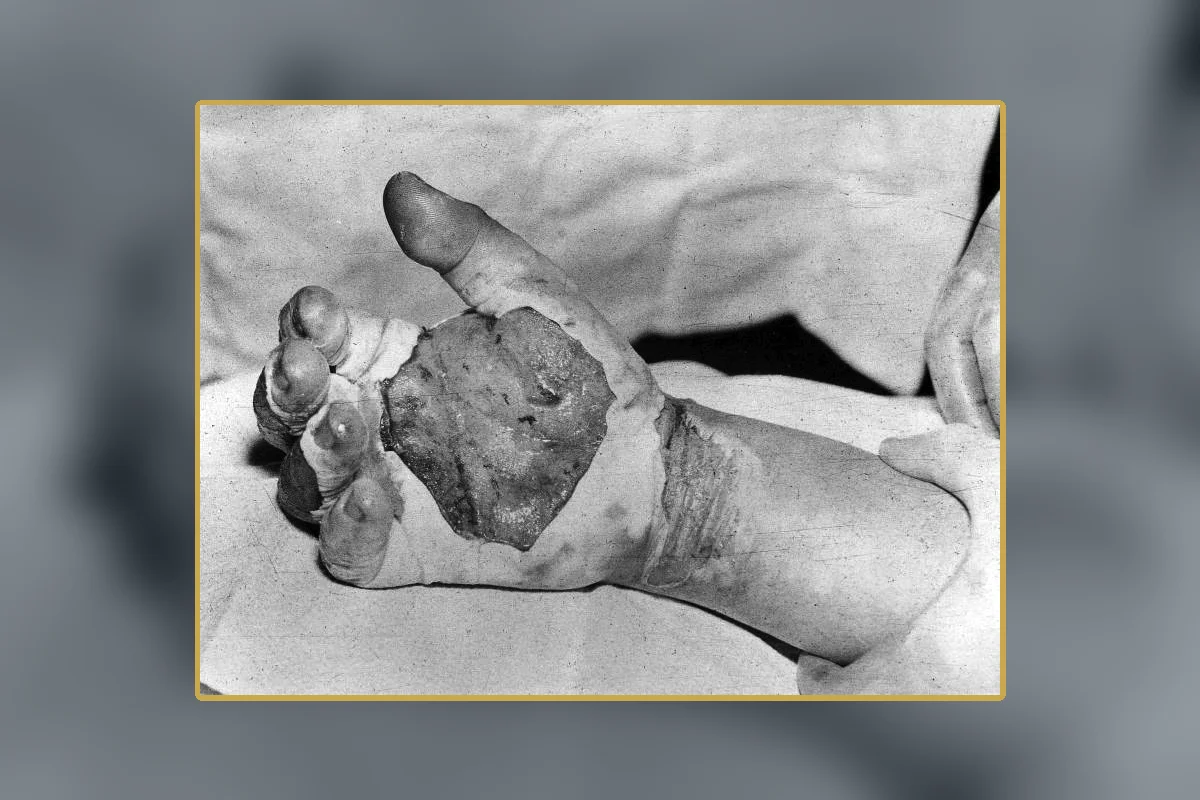Harry Daghlian's radiation-injured hand during medical treatment